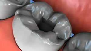 Root Canal